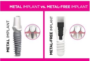 singapore metal free dental implants