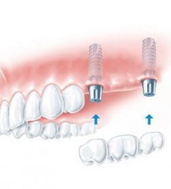 A2djacentTeeth-300x277