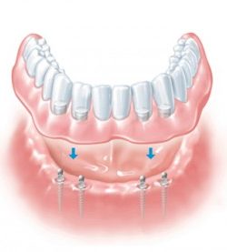 D4enturesOnImplants-300x277