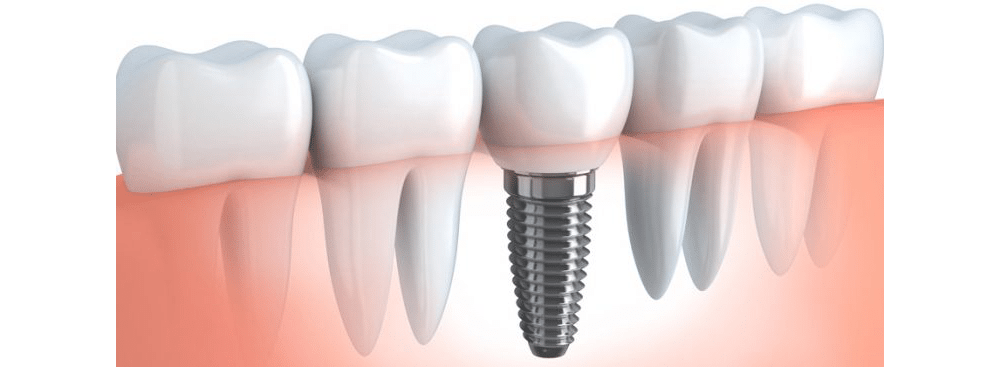 Single Tooth Dental Implant Singapore - The Dental Implant Centre