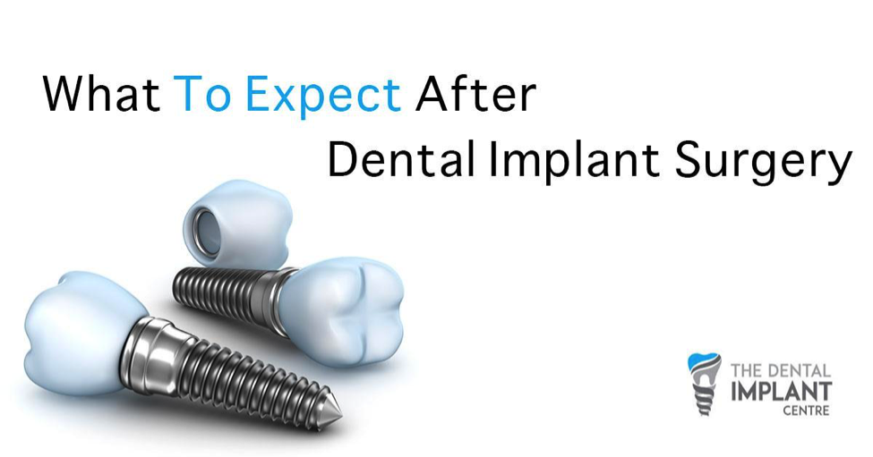 What to Expect During a Dental Implant Procedure